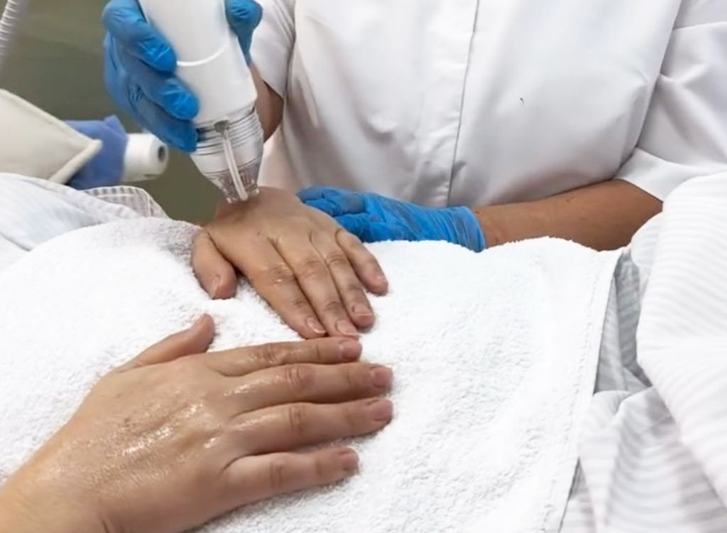 Радиоволновый лифтинг кистей рук